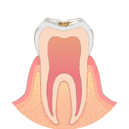 歯の表面に虫歯ができます