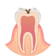 虫歯が神経に近くなり、冷たいものがしみます