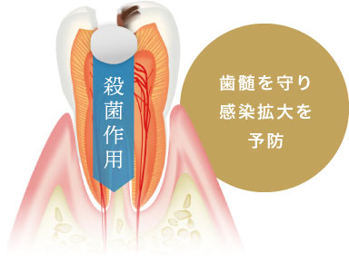 歯髄を守り感染拡大を予防