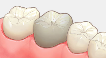 歯をなるべく残す治療