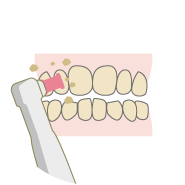 歯のクリーニング歯垢・歯石の除去