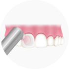歯の表面をツルツルに仕上げ磨き