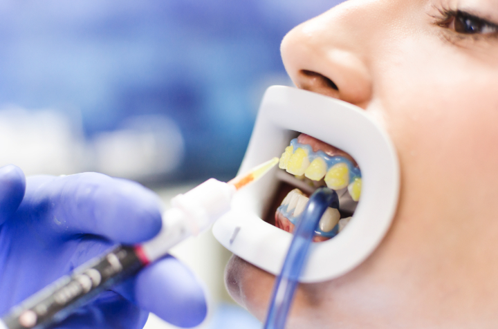 オフィスホワイトニングの様子