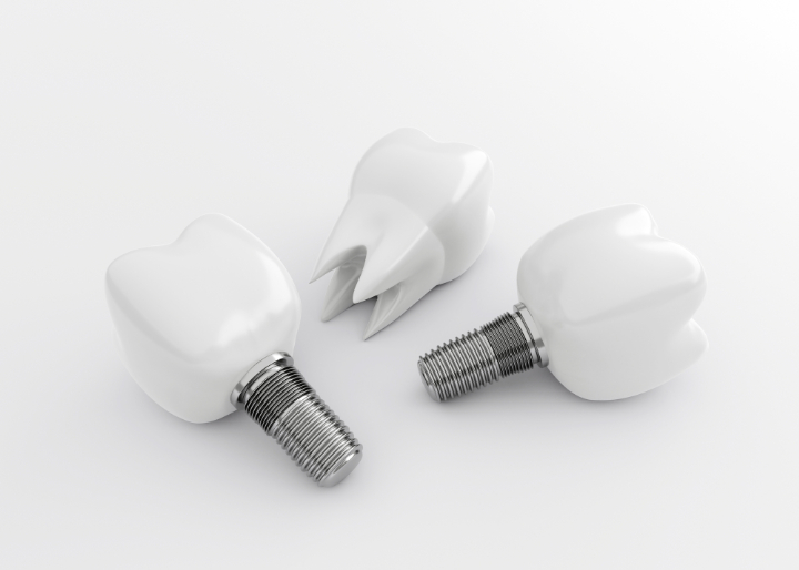 インプラントの歯