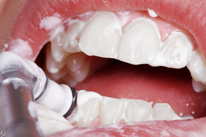 PMTCの施術の様子