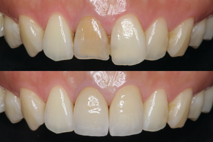 ダイレクトボンディングのビフォーアフター