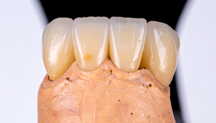 経年変化で変色したダイレクトボンディングした歯