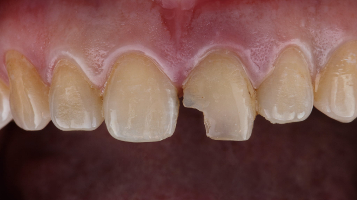 ダイレクトボンディングに向かない大きく欠けた歯