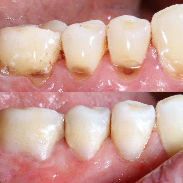 ダイレクトボンディングの前後のイメージ