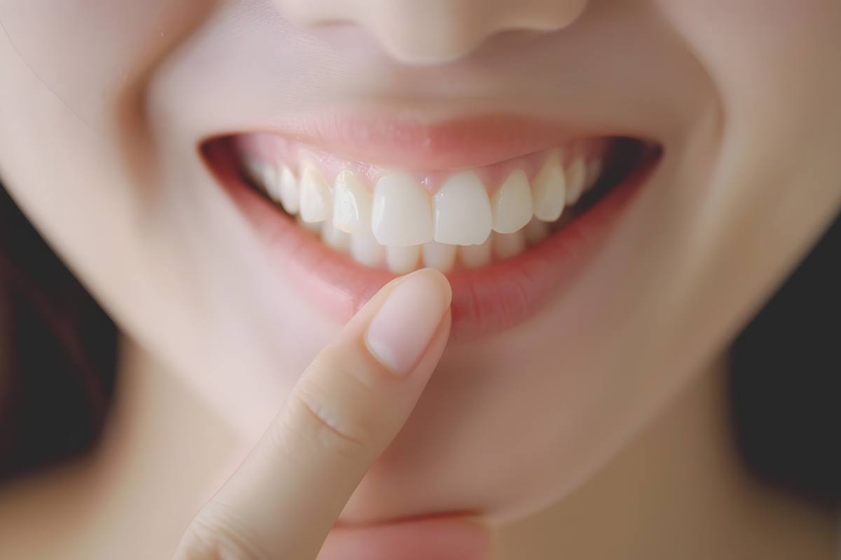 ダイレクトボンディング治療した歯