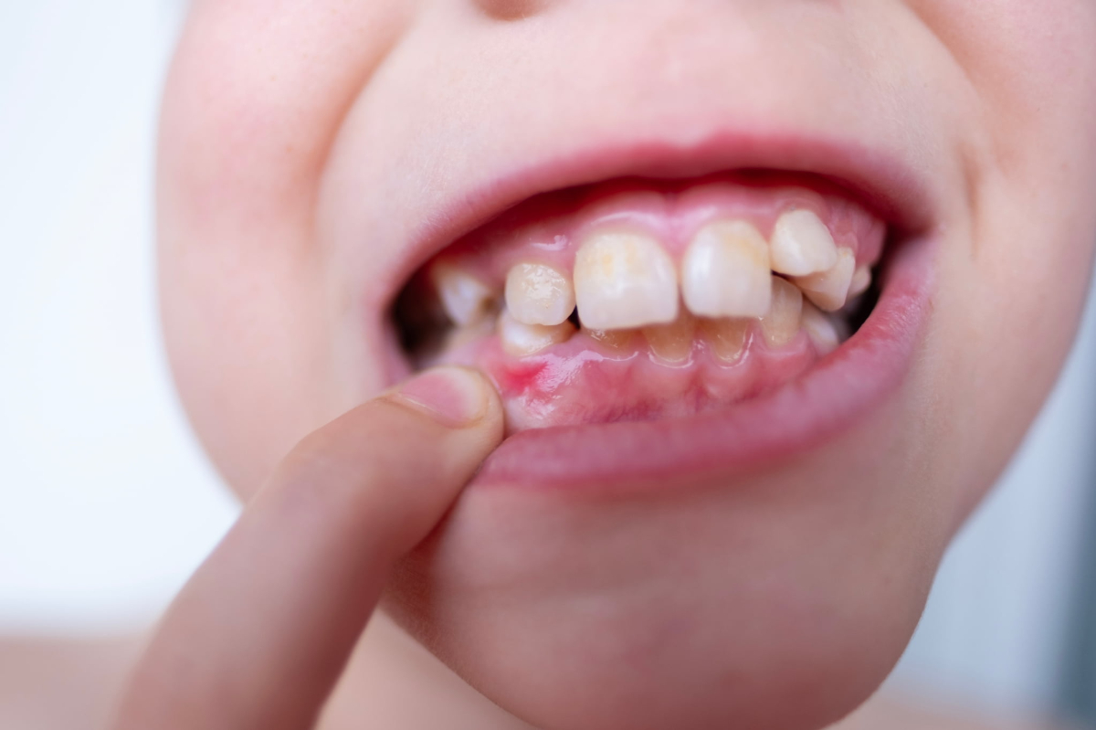 口臭の原因になる歯みがきの不十分な歯と歯肉炎